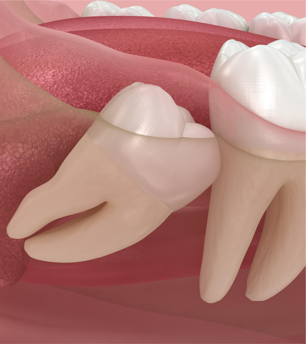 What Are Dental Crowns?